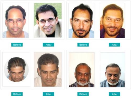 Enhance Clinics is now recognized as one of the leading clinics for Hair  Transplant in India | Enhance Clinics- Hair Transplant, Cosmetic Surgery,  Liposuction